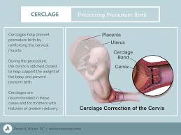 This might lead to swelling in your legs due to fluid build up. Incompetent Cervix Signs Symptoms Diagnosis Treatment