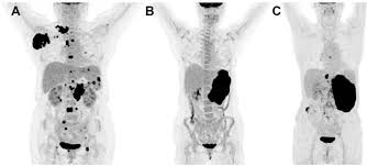 How do physicians perform a bone marrow aspiration and/or biopsy? Prognostic Value Of Bone Marrow Fdg Uptake Pattern Of Pet Ct In Newly Diagnosed Diffuse Large B Cell Lymphoma