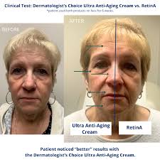 A Tretinoin Before and After. Plus, the RetinA OTC alternative.