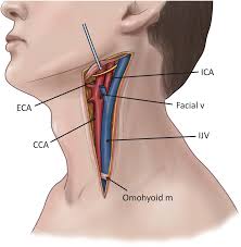 Our carotid artery test identifies plaque build up & risk of stroke & vascular disease. Carotid Artery And Internal Jugular Vein Injuries Chapter 8 Atlas Of Surgical Techniques In Trauma
