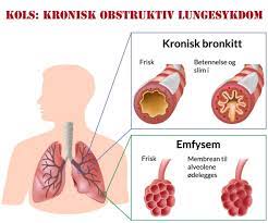 Kols Kronisk Obstruktiv Lungesykdom Lommelegen