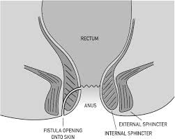 A fistula is an epithelialized tunnel. Anal Fistulas Guts Uk
