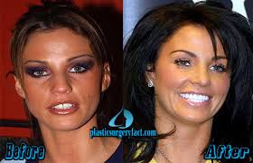 In a video shared on the platform, in which she discussed a as long as your teeth are aligned, veneers require minimal to no preparation whatsoever. Katie Price Plastic Surgery Katie Price Before And After Veneers Plastic Surgery Facts