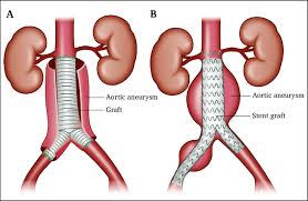 A thoracic aortic aneurysm is a weakened area in the major blood vessel that feeds blood to the body (aorta). 2 A Open Surgery For An Abdominal Aortic Aneurysm Open Aaa Repair Download Scientific Diagram