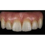 MiYo and Monolithic Zirconia Hybrids