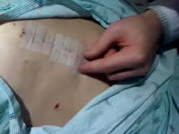 How to apply steri strips to close a wound. Feb 21 2012 Incision Steri Strip Coverings Youtube