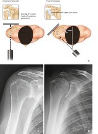 Acromion is an anterolateral oblong projection of the spine of scapula (shoulder blade) that runs laterally then anteriorly above the supraspinous fossa and is the summit the acromion arches over the glenohumeral joint and articulates with the clavicle (collarbone) to form the acromioclavicular joint. Subacromial Space Musculoskeletal Key