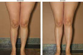 Calf Augmentation Before And After Pictures Dr Turowski Plastic Surgery Chicago