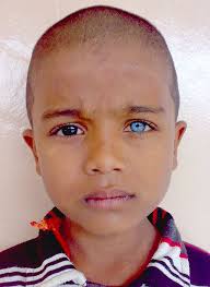 Black And Blue Eyes After Head Injury Heterochromia Anatomybox Beautiful Eyes Cool Eyes Stunning Eyes