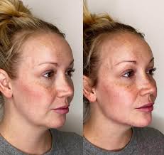 Shari Ortiz — Botox, Filler, Fat Removal │ Aluma Medical Aesthetics