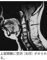 ○ 概要 １． 概要 脊髄性筋萎縮症（spinal muscular atrophy：sma）は、脊髄の前角細胞の変性による筋萎縮と進行性筋力低下を特徴とする下位運動ニューロン病である。 è„Šé«„ç©ºæ´žç—‡ã¨ã¯ åŒ»ç™‚ç·åˆqlife