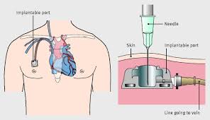 Central Venous Catheters Bmj Central Venous Catheter Catheter Nursing Study