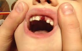 Image result for Tooth Avulsion
