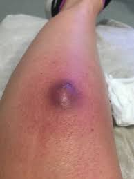 What to look for, how to identify one and just what. False Widow Spider Bites Mum As She Gets Into Bed Leaving Her With Huge Black Rotting Hole In Her Leg Mirror Online