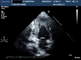 This form of stress testing is usually performed with exercise protocols using either a treadmill or bicycle. Echocardiography In Patients With Hypertrophic Cardiomyopathy Usefulness Of Old And New Techniques In The Diagnosis And Pathophysiological Assessment Cardiovascular Ultrasound Full Text