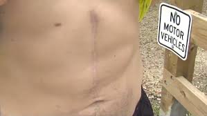 People with stomach cancer may experience the following symptoms or signs. Lowcountry Man Has Stomach Removed Due To Cancer Causing Disease Now Competing In Ironman Wciv