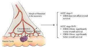 Medical college of georgia at augusta university Frontiers The Circumferential Resection Margin Is A Prognostic Predictor In Colon Cancer Oncology