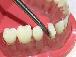 Anglevator Extraction Kit Tooth Extraction Aftercare Tooth Extraction Healing Tooth Extraction