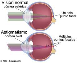 Resultado de imagen para astigmatismo