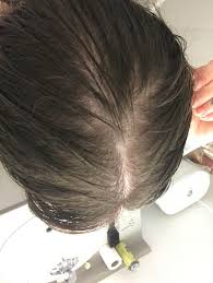 The biggest misconception is that fine hair doesn't require a lot of conditioning, says hall. 30 Y O Female Is My Hair Thinning Or Just Bad Lightening It S Wet Here I Just Showered Super Concerned Hairloss