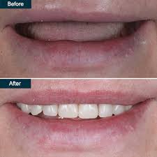 Once the swelling subsides and the gums shrink, this appearance. Affordable Dentures Full Or Partial In Brooklyn Ny Dentures Repair