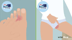 How To Cure Jock Itch 13 Steps With Pictures Wikihow