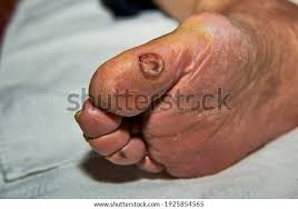 Image result for toe black diabetes