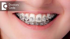 Orthodontic records and paperwork may take additional time. How Long Will It Take To Close The Gaps With Invisible Braces Dr Shobith R Shetty Youtube