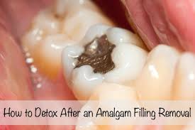 Amalgam filling need time to harden, several hours. How To Detox After An Amalgam Filling Removal Deliciously Organic
