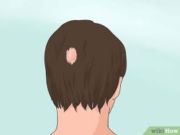 Telogen effluvium telogen is the part of the normal hair growth cycle when hairs stop growing and rest. 4 Ways To Stop Teen Hair Loss Wikihow