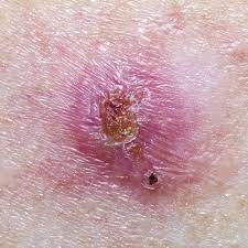 Remember that it's important to get any suspicious spots checked out your derm will do a visual exam to look for any irregular marks or moles on your skin. Melanoma Pictures Symptoms What Does Melanoma Look Like