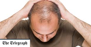 Receding hairline products on the site are advanced formulations of rich minerals such as keratin, formaldehyde keratin protein, and more, that nourish your hair and treat it in. Hair Loss Treatments Which Ones Really Work