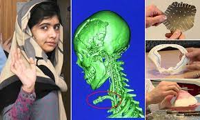 Check spelling or type a new query. Malala Yousafzai Taliban Shooting Victim To Undergo Final Brain Operation Daily Mail Online