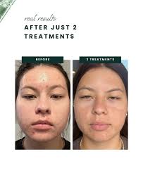 Meet the Microneedling Clear + Even Clarifier Catalyst Serum ✨⁠💚💧 ⁠ Why  it works: Powered by anti-inflammatory and antibacterial plant-based  phytonutrients, this serum soothes active breakouts, supports barrier  repair, and calms reactive