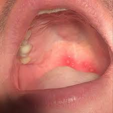Image result for Oral herpes roof of mouth