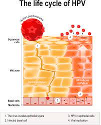 We don't know for sure how hpv causes head and neck cancer. Oral Hpv And Oral Cancer La Periodontics Implant Specialists