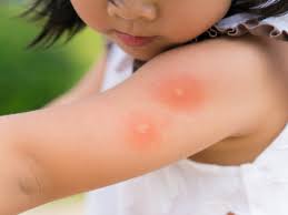 After watching this video you will know how to. How To Get Rid Of Mosquito Bites And Stop The Itch