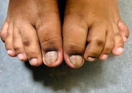 Image result for Onychotillomania feet