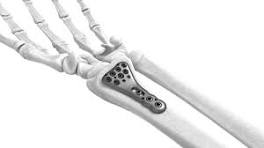 Plates | ITS Implant - USA