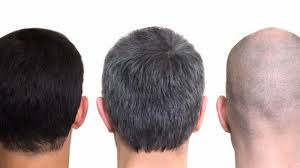 Tapi berapa helai rambut rontok dalam sehari yang masiih dikatakan normal? Uban Rontok Tumbuh Rambut Hitam Caranya Makan Ini Tribun Timur