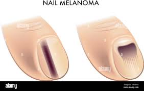 Melanoma nail hi-res stock photography and images - Alamy
