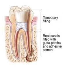 Root Canal Dentist Can Be Helpful If For Any Reason The Dental Pulp Is Injured Or The Pulp Of The Tooth Is Affect Root Canal Root Canal Treatment Dental Crowns