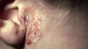 Maybe you would like to learn more about one of these? Bilder Pa Vanliga Hudutslag Och Prickar Netdoktor