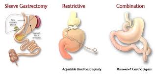 Pin On Gastric Bypass Reviews Options