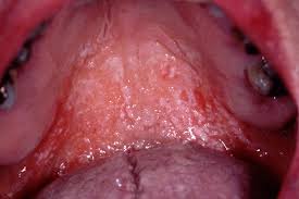 Image result for oral thrush symptoms roof of the mouth