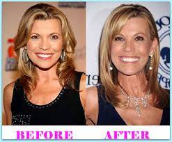 Popular vanna white plastic surgery | easy vanna white plastic surgery at home | inspired for vanna white plastic surgery for stylist | awesome vanna white . Vanna White Have Plastic Surgery Plastic Surgery Before And After