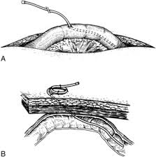 Here, we describe a novel technique for lj, using a single barbed suture for securing the bowel and tunnelling the. Percutaneous Tube Management Musculoskeletal Key