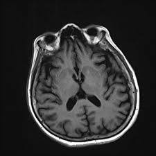 In lbd, protein deposits build up in the brain. Dementia With Lewy Bodies Radiology Reference Article Radiopaedia Org