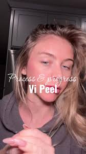 day 5 of the VI Peel ✨ the peeling is peeling, but the glow is glowing  she’s flaking her way to flawless 💅🏼 stay tuned 🧖‍♀️ #VIPeel #skincare  #skinjourney #Peel #skintransformation