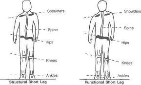 Image result for Functional Leg Length Discrepancy